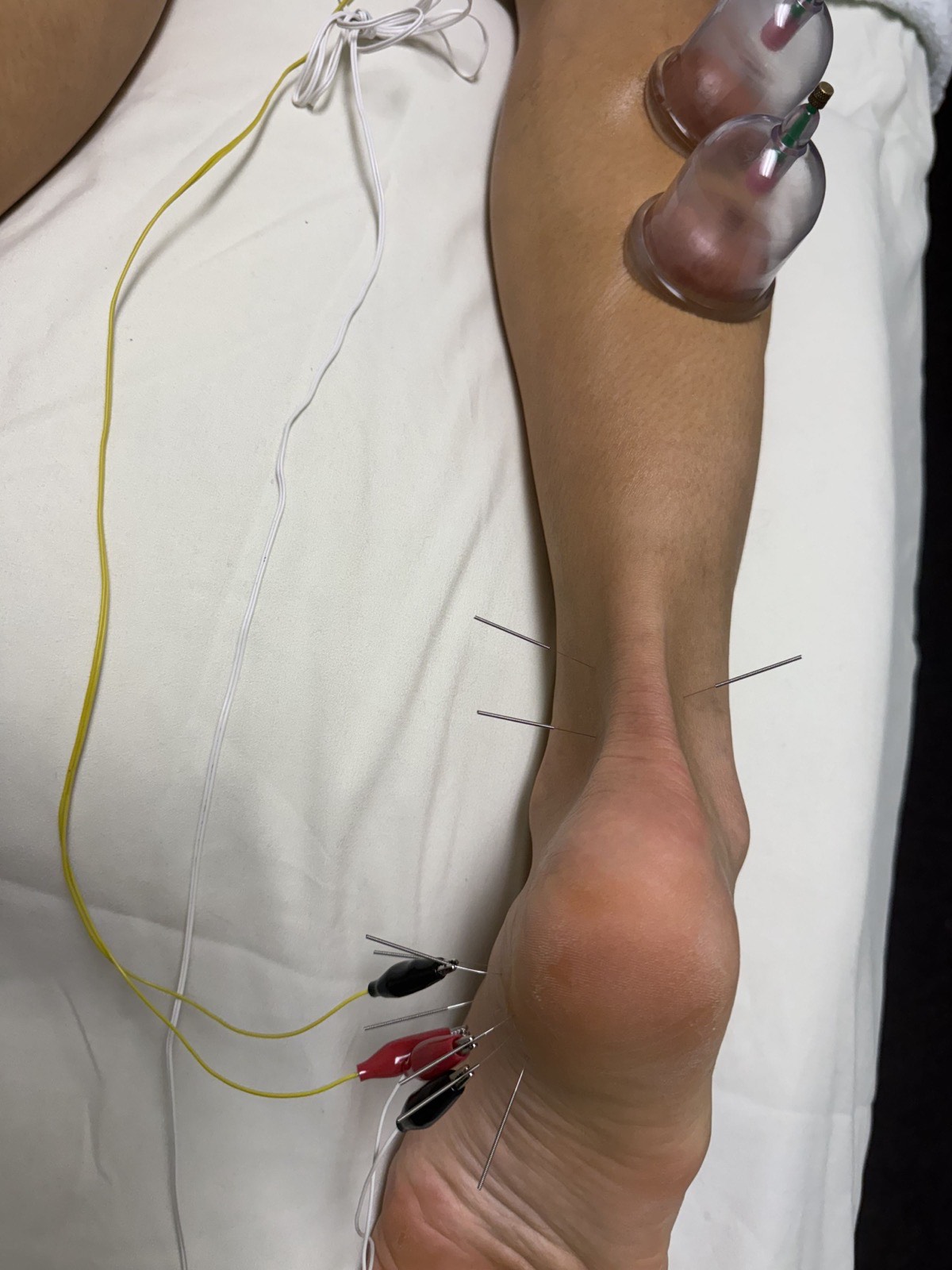 Shizue Hayashi Ito Acupuncture｜カリフォルニア州コスタメサ